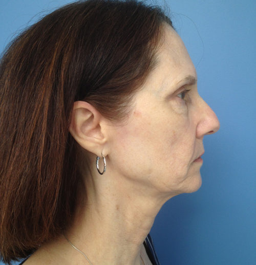 Face & Neck Lift