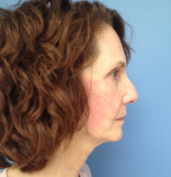 Face & Neck Lift