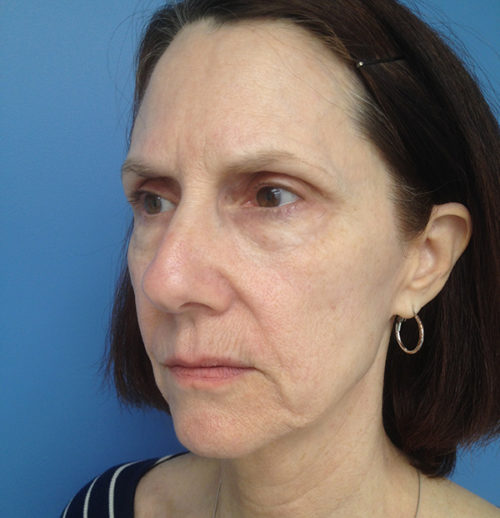 Face & Neck Lift