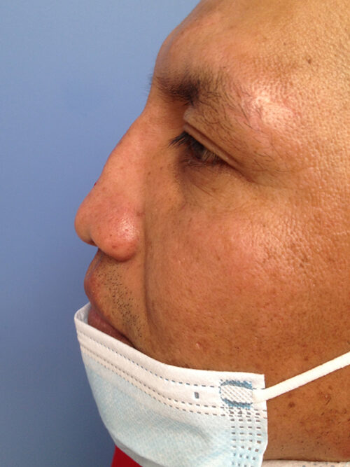 Other Nasal Procedures