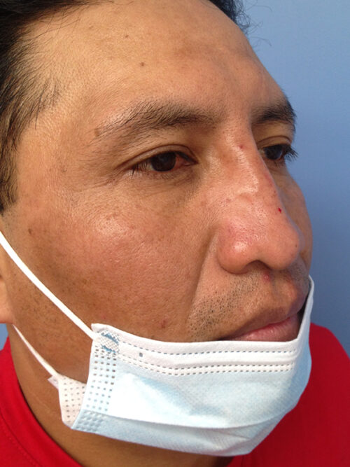 Other Nasal Procedures