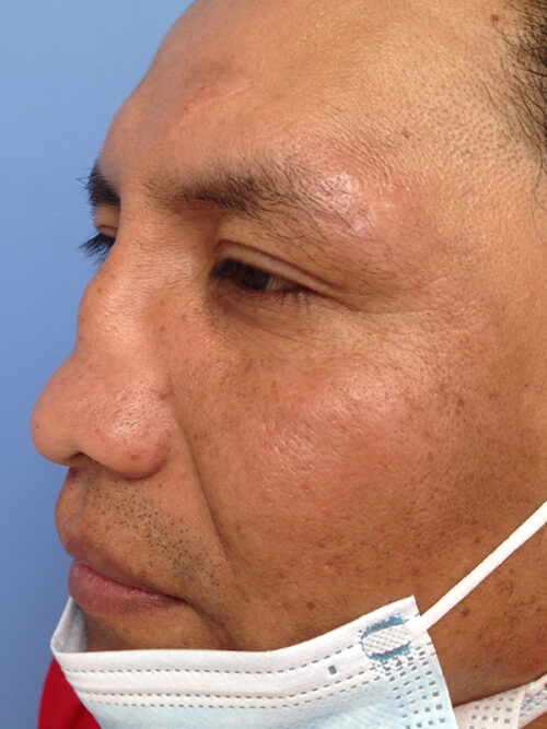 Other Nasal Procedures