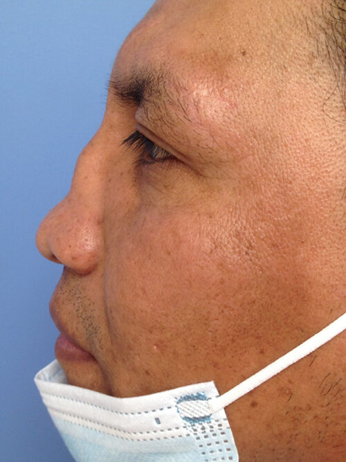 Other Nasal Procedures