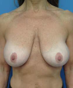 Breast Lift/Augmentation