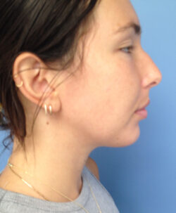 Chin Augmentation