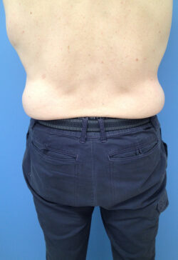 Male Abdominoplasty/Body Lift