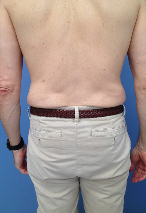 Male Abdominoplasty/Body Lift