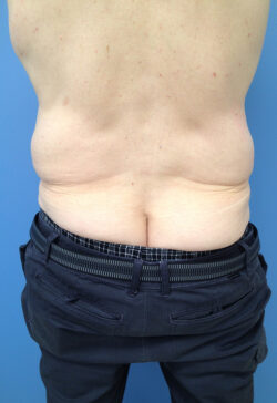 Male Abdominoplasty/Body Lift