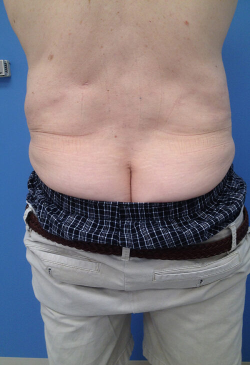 Male Abdominoplasty/Body Lift