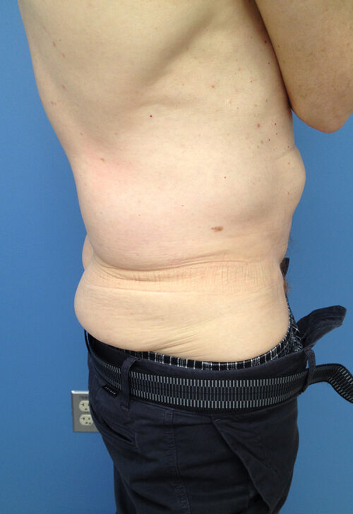 Male Abdominoplasty/Body Lift