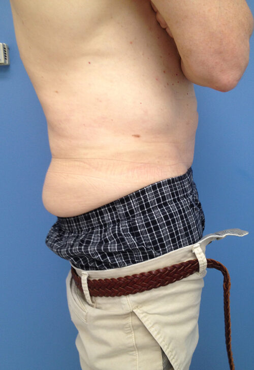 Male Abdominoplasty/Body Lift