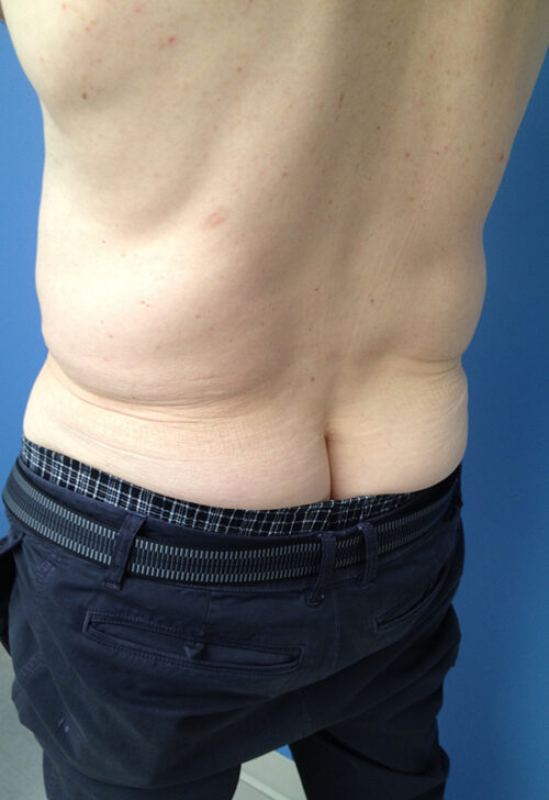 Male Abdominoplasty/Body Lift