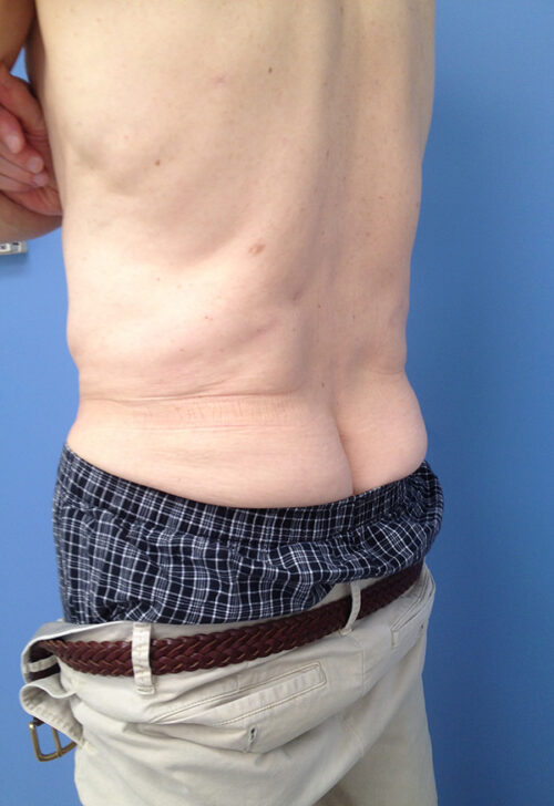 Male Abdominoplasty/Body Lift