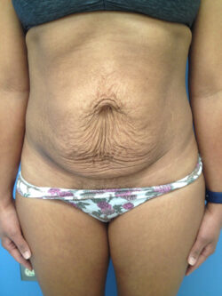 Tummy Tuck (Abdominoplasty)