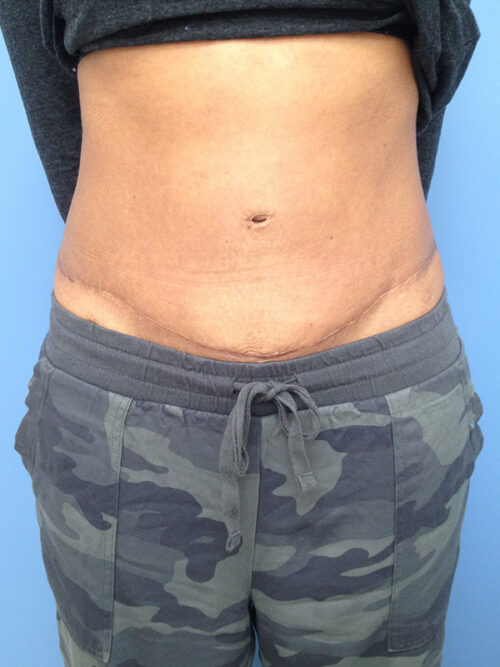 Tummy Tuck (Abdominoplasty)