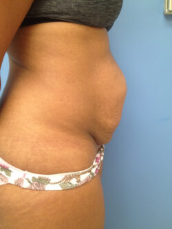 Tummy Tuck (Abdominoplasty)