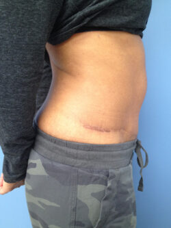 Tummy Tuck (Abdominoplasty)