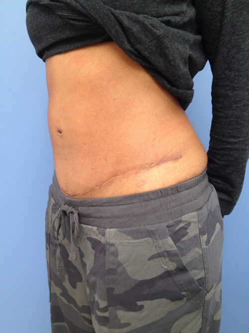 Tummy Tuck (Abdominoplasty)