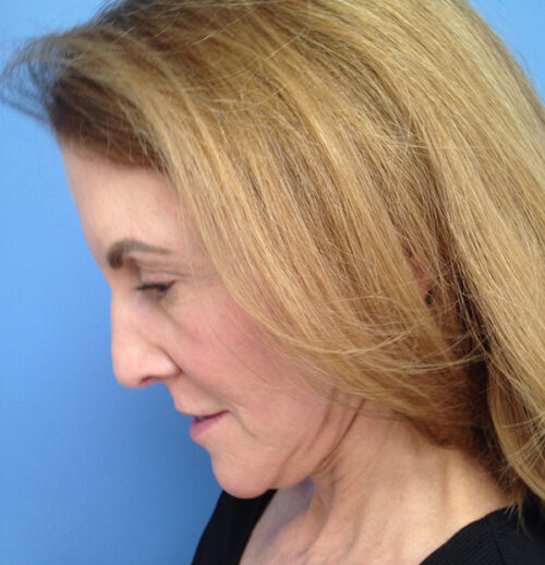 Face & Neck Lift Case 1845 After Photo Face & Neck Lift