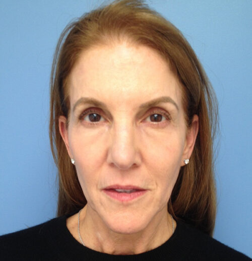 Face & Neck Lift Case 1845 Before Photo Face & Neck Lift
