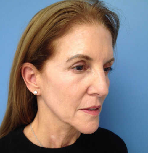Face & Neck Lift Case 1845 Before Photo Face & Neck Lift