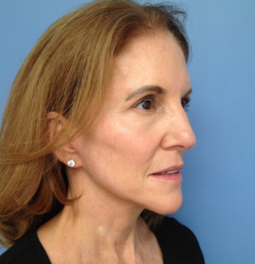 Face & Neck Lift Case 1845 After Photo Face & Neck Lift