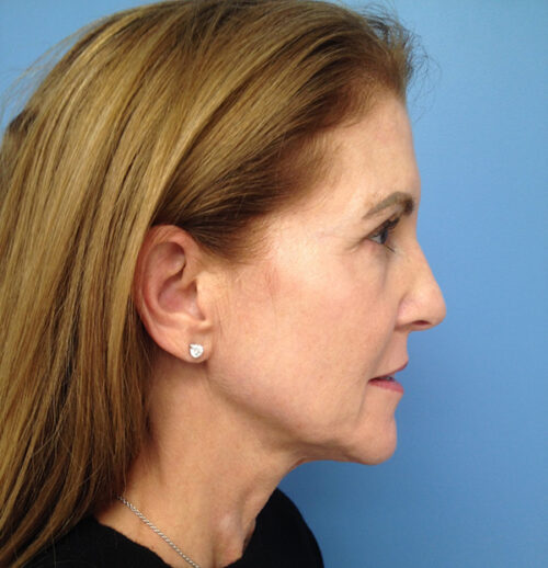 Face & Neck Lift Case 1845 Before Photo Face & Neck Lift