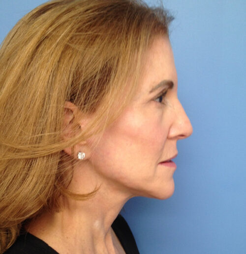 Face & Neck Lift Case 1845 After Photo Face & Neck Lift