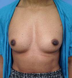 Other Breast Procedures