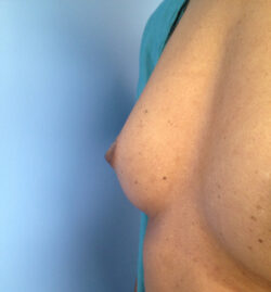 Other Breast Procedures