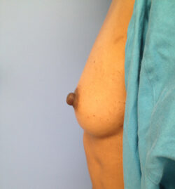 Other Breast Procedures