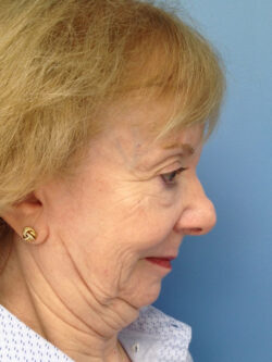 Other Nasal Procedures