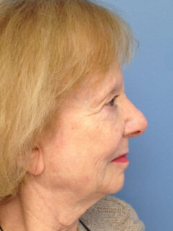 Other Nasal Procedures