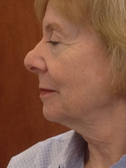 Other Nasal Procedures