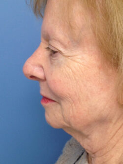 Other Nasal Procedures