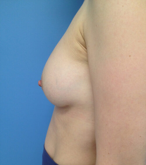 Breast Augmentation Case 1882 After Photo Breast Augmentation
