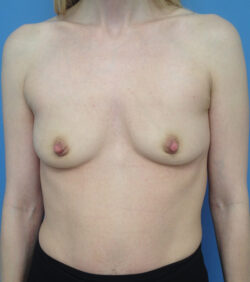 Breast Augmentation