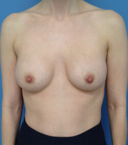 Breast Augmentation