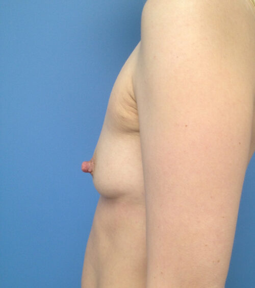 Breast Augmentation Case 1882 Before Photo Breast Augmentation