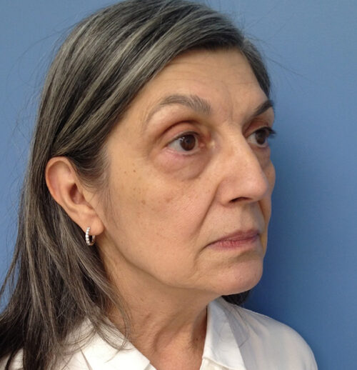 Face & Neck Lift Case 1856 Before Photo Face & Neck Lift