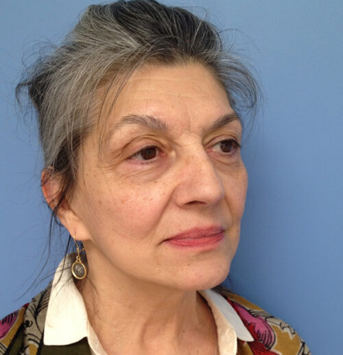 Face & Neck Lift Case 1856 After Photo Face & Neck Lift