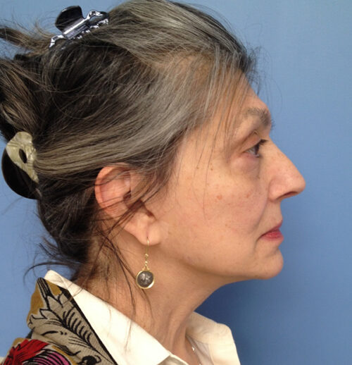 Face & Neck Lift Case 1856 After Photo Face & Neck Lift