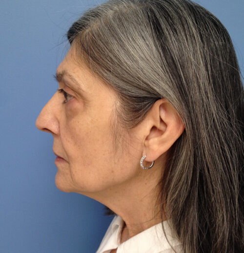 Face & Neck Lift Case 1856 Before Photo Face & Neck Lift