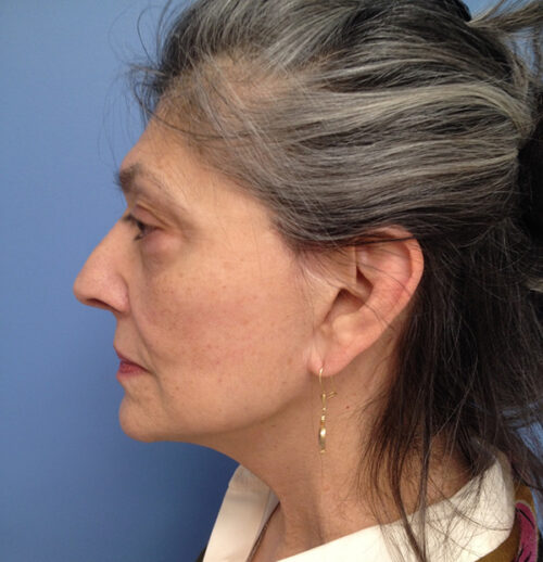 Face & Neck Lift Case 1856 After Photo Face & Neck Lift