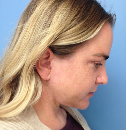 Face & Neck Lift