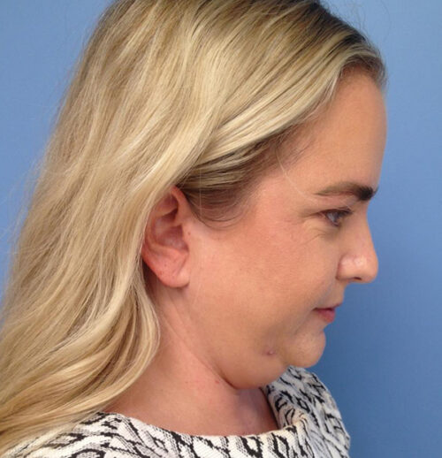 Face & Neck Lift
