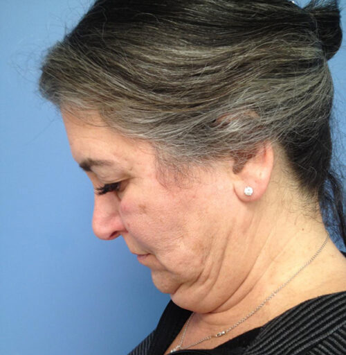 Eyelid Surgery