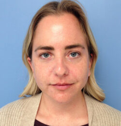 Face & Neck Lift