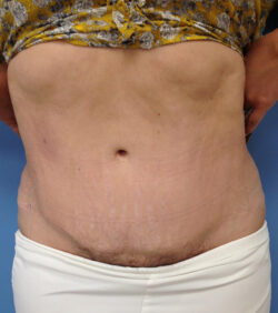 Tummy Tuck (Abdominoplasty) Before and After Photos
