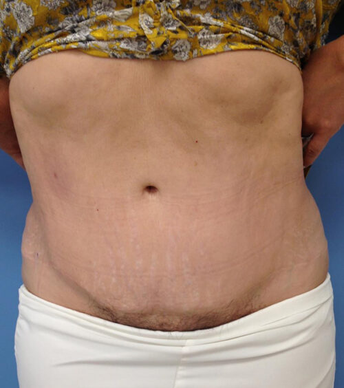 Tummy Tuck (Abdominoplasty) Before and After Photos